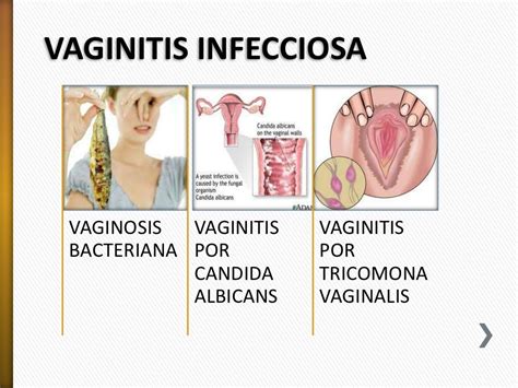 infección vaginal